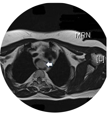 Specialized Care for Airway Tumors